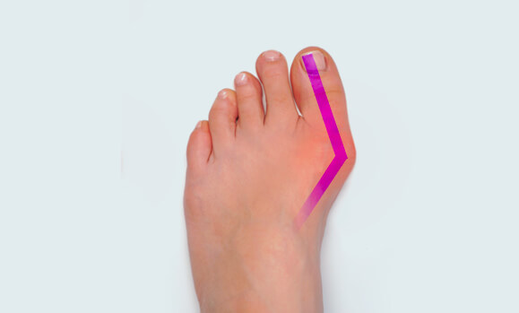 Severe Bunion