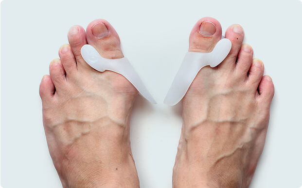 Treating Options For Bunion