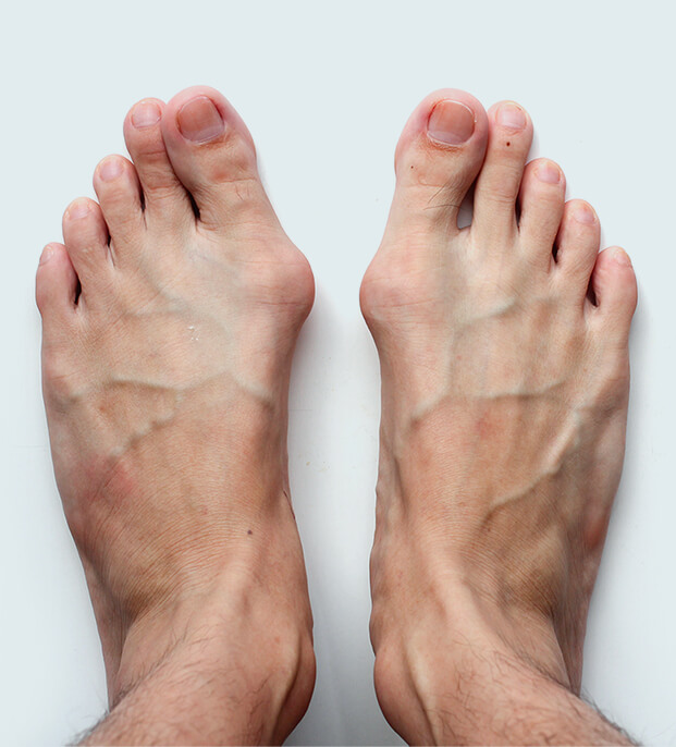 Visible Bunion Symptoms